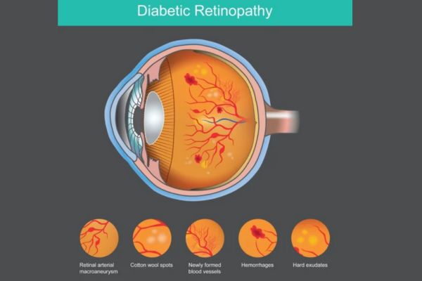Diabetic Retinopathy